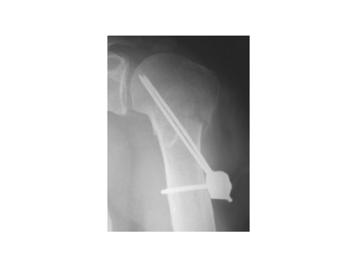 humerus_block_1
