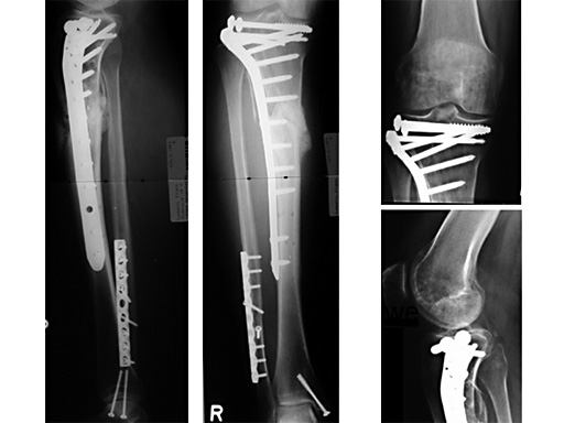 prox_lateral_tibia_liss_3