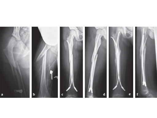 end-cap-for-elastic-nails-case-01