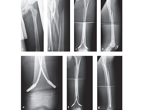 end-cap-for-elastic-nails-case-02