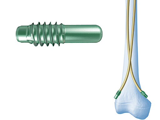 end-cap-for-elastic-nails