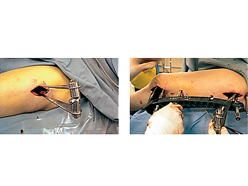 hohmann-retractor-holder-case