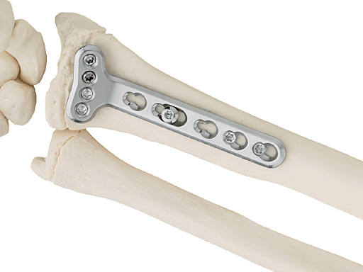 lcp-extraarticulaar-voltar