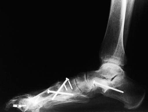 Locking_2_hole_plate_001