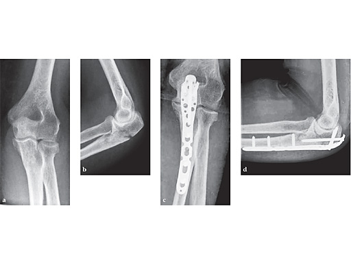 olecranon-plate-case