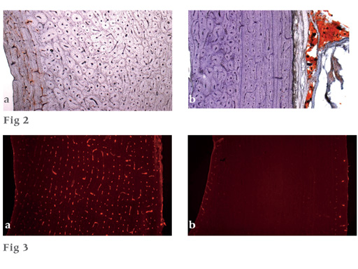 ria_vs_unreamed_nail_2