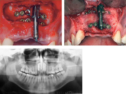 Alveolar-Distractor-case-02