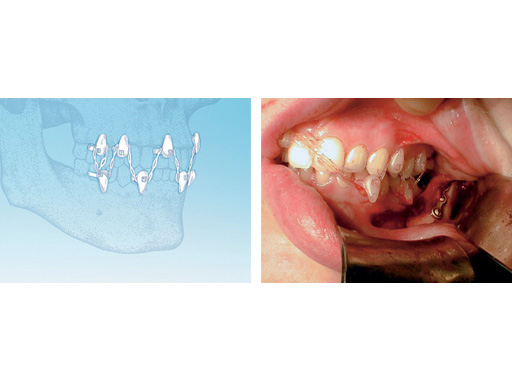 Rapid-IMF-System-case