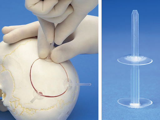 Resorbable_Cranial_Clamp