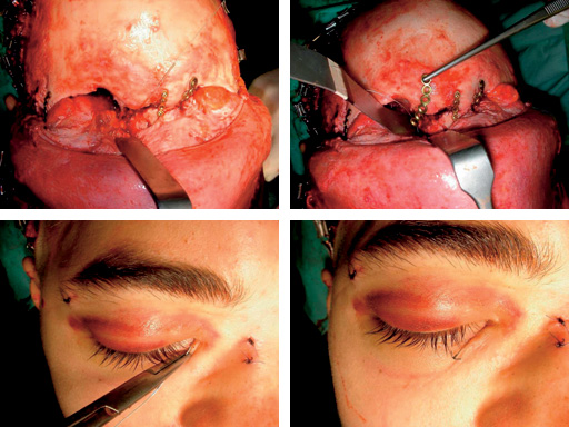 titanium-wire-needle-case