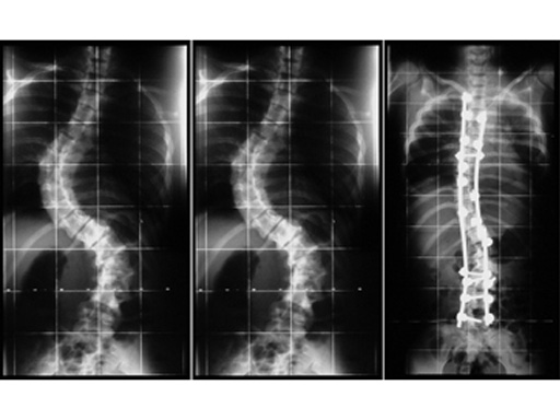 uss_ped_screw_case_1