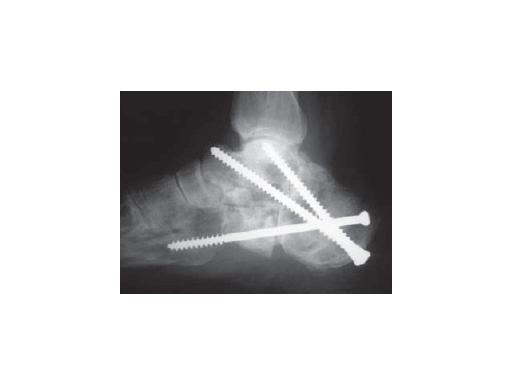 Cancellous_Screw_core_diameter_2