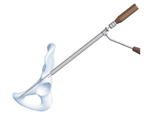 Cannulated_Percutaneous_Guiding_System_1