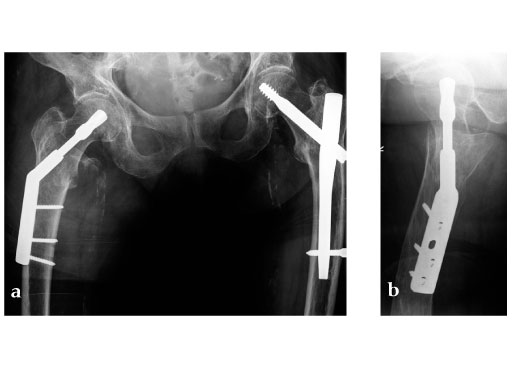Dynamic_Hip_Screw_Blade_3