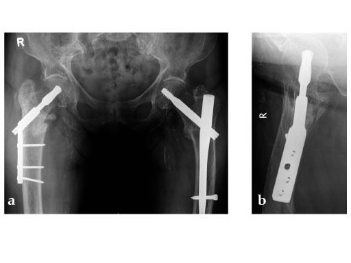 Dynamic_Hip_Screw_Blade_4