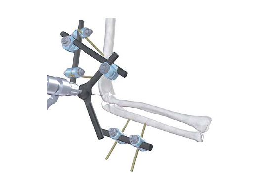Elbow_Hinge_Fixator_1