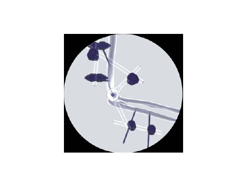 Elbow_Hinge_Fixator_2