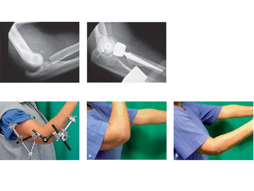 Elbow_Hinge_Fixator_3