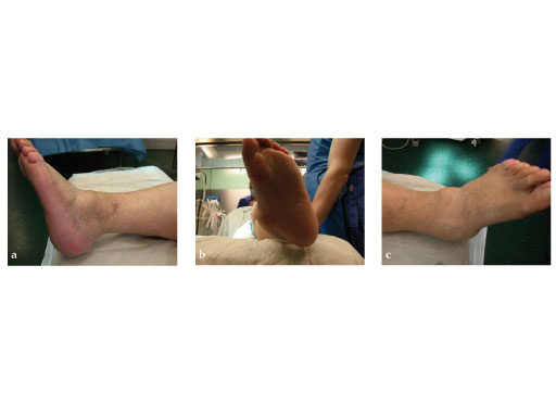 Expert_Hindfoot_Arthrodesis_Nail_3