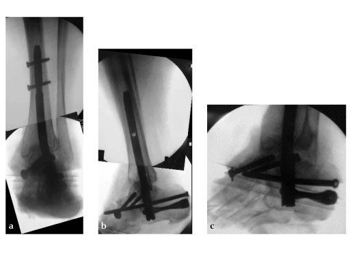 Expert_Hindfoot_Arthrodesis_Nail_4