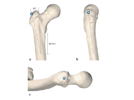 expert_lat_femoral_nail_1