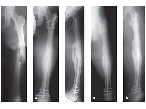 expert_lat_femoral_nail_3