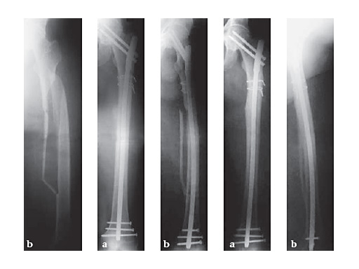 expert_lat_femoral_nail_5