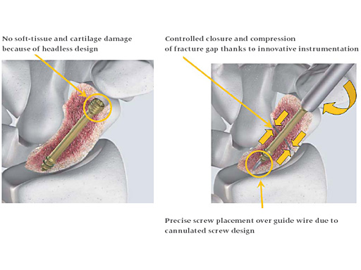 headless_compression_screw_2