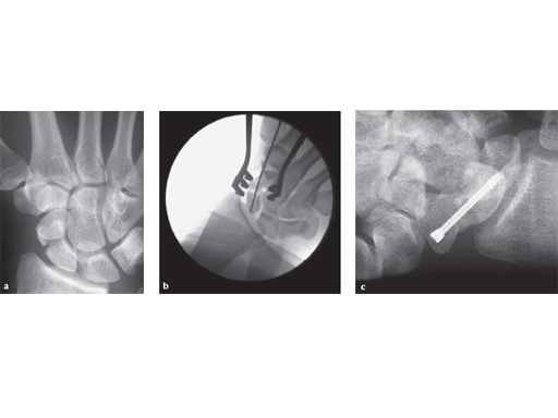 headless_compression_screw_3