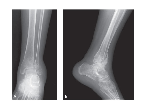 LCP_Anterolateral_DTP-3-5_2