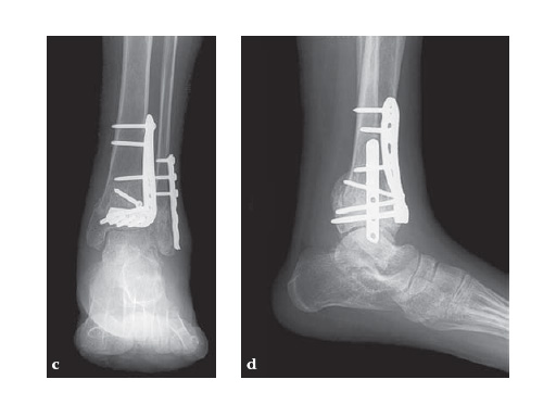 LCP_Anterolateral_DTP-3-5_3