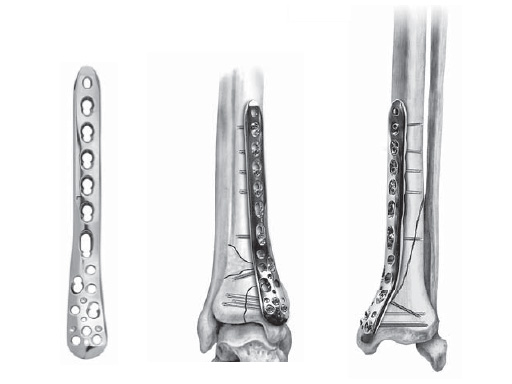 LCP_Medial_DT_Plate_3-5_1