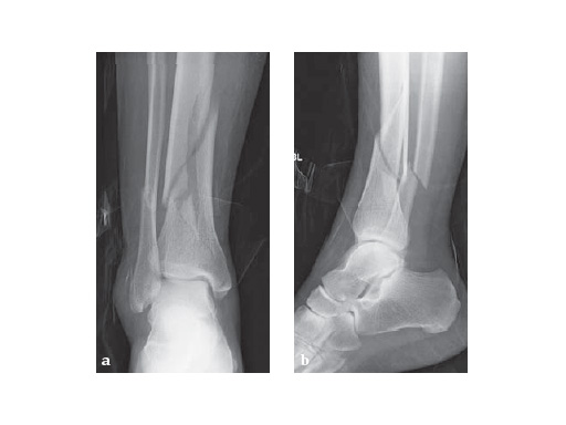 LCP_Medial_DT_Plate_3-5_2