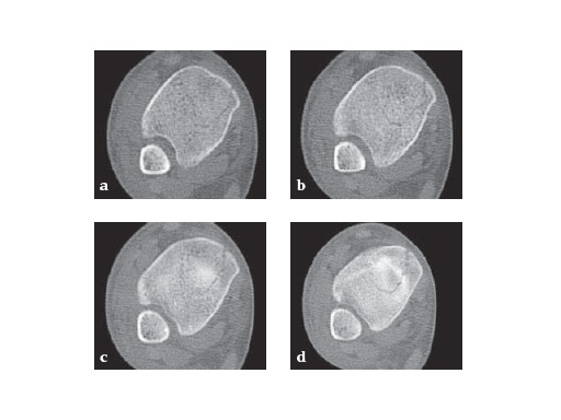 LCP_Medial_DT_Plate_3-5_3