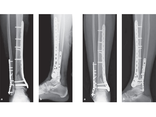 LCP_Medial_DT_Plate_3-5_4