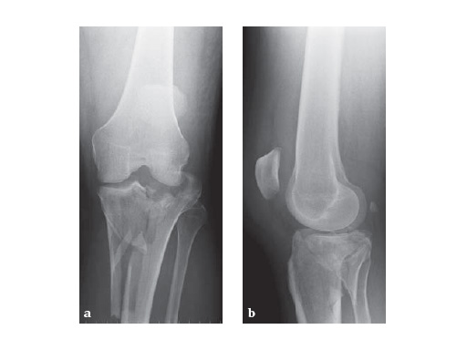 LCP_Medial_Proximal_Tibia_Plate_2