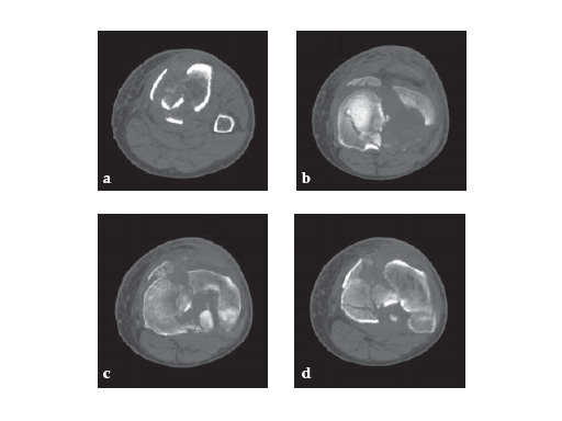 LCP_Medial_Proximal_Tibia_Plate_3