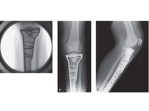 LCP_Medial_Proximal_Tibia_Plate_4