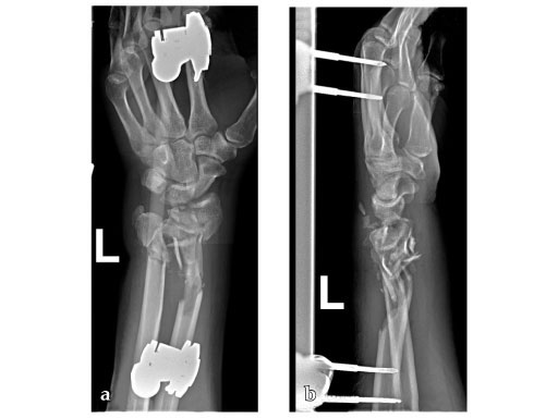 LCP_MetaDiaphyseal_Vol_DR_Plate_2