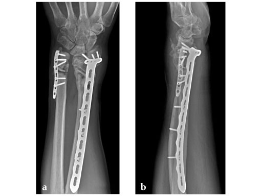 LCP_MetaDiaphyseal_Vol_DR_Plate_3