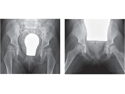 LCP_Pediatric_Hip_Plate_2