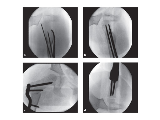 LCP_Pediatric_Hip_Plate_3