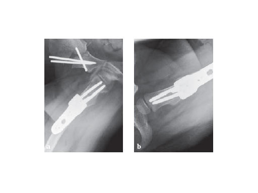 LCP_Pediatric_Hip_Plate_4