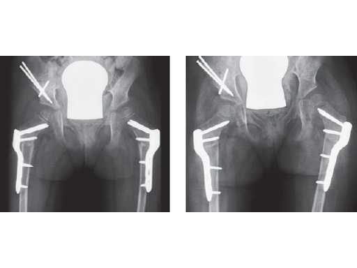 LCP_Pediatric_Hip_Plate_5