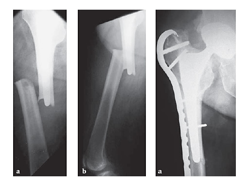 LCP_Proximal_Femoral_Hook_Plate-4_5_2