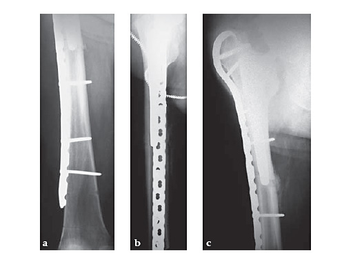 LCP_Proximal_Femoral_Hook_Plate-4_5_3