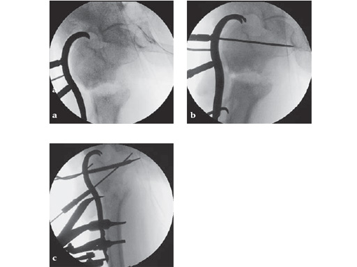 LCP_Proximal_Femoral_Hook_Plate-4_5_4