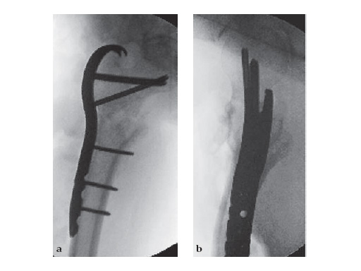 LCP_Proximal_Femoral_Hook_Plate-4_5_5