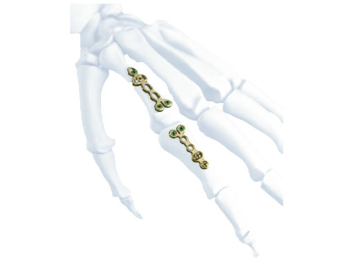 LCP_Rotation_Correction_Plate_2-0_1