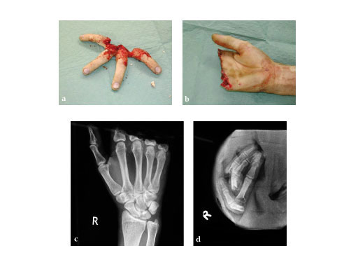 LCP_Rotation_Correction_Plate_2-0_2
